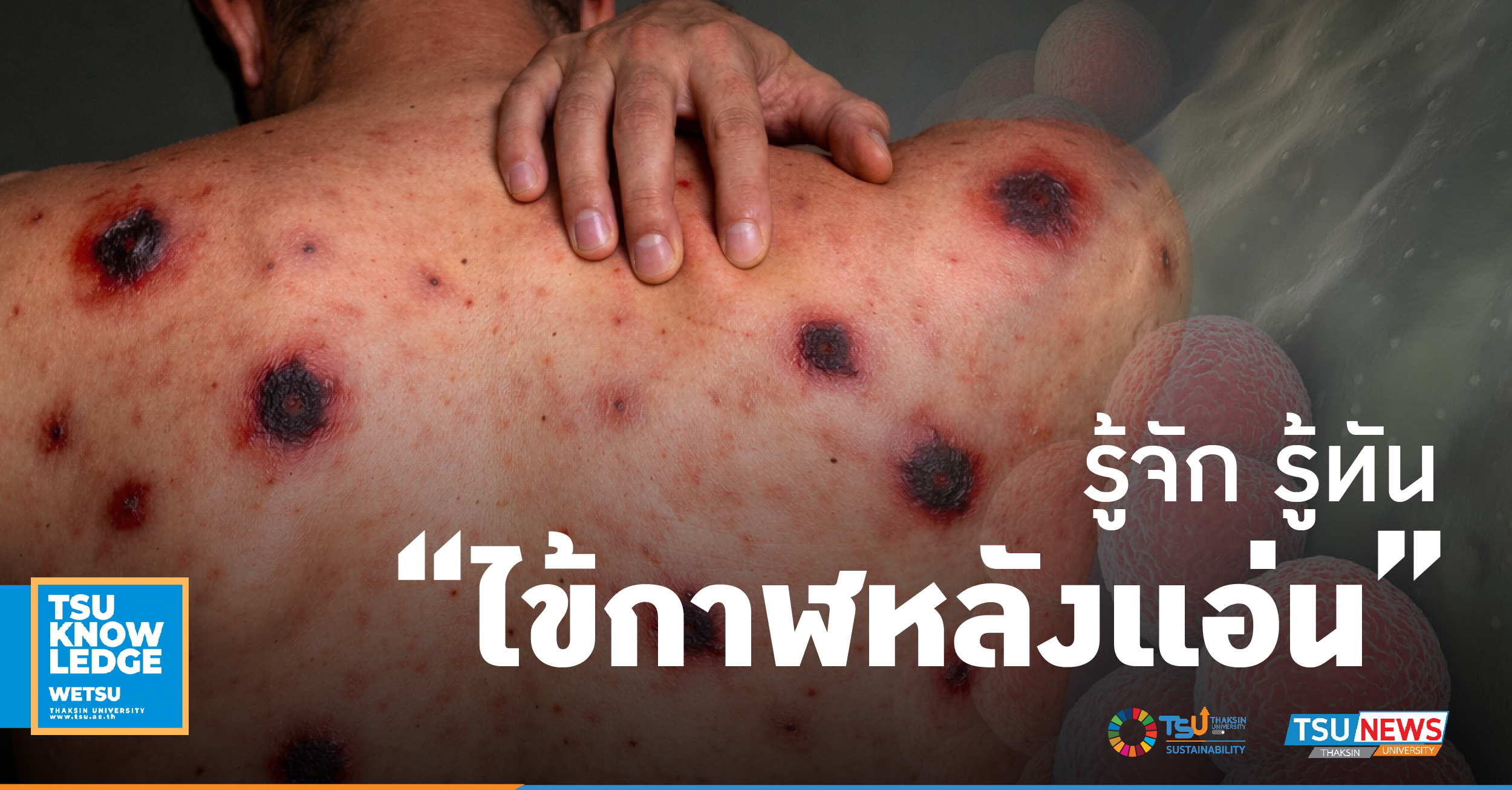 รู้จัก รู้ทัน ไข้กาฬหลังแอ่น